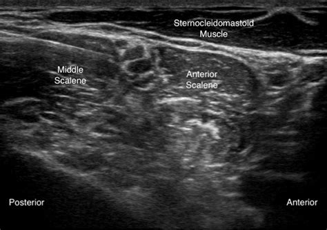 Ultrasound view of interscalene nerve block depicting orientation of... | Download Scientific ...