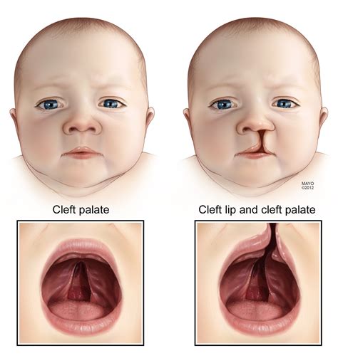 TUESDAY Q & A: Timing of surgery to repair cleft lip can’t be determined until baby is born ...