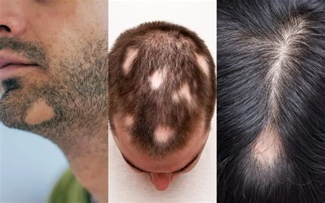 Alopecia Areata: Circular or Patchy Hair Loss