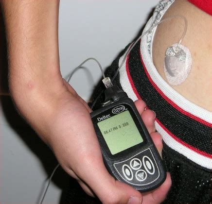 Diabetes & Innovation: Insulin Pumps + CGMs = Artificial Pancreas