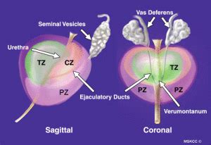 Prostate Zone Anatomy, Prostate Cancer and Imaging - Sperling Prostate Center