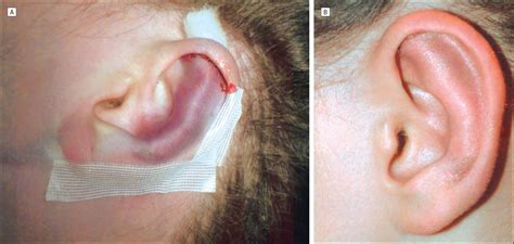 Antihelix Plasty Without Modeling Sutures | JAMA Facial Plastic Surgery | JAMA Network