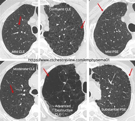 COPD - CT Chest Review