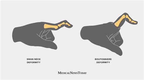 Swan neck deformity: Causes and treatment