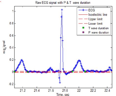 ECG signal with isoelectric line and P and T wave durations | Download Scientific Diagram