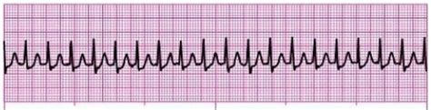 Identifying and Treating Supraventricular Tachycardia (SVT)