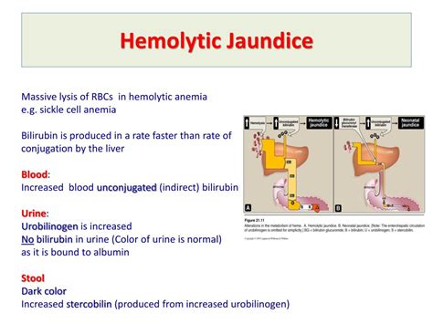 PPT - Bilirubin Metabolism & Jaundice PowerPoint Presentation, free ...