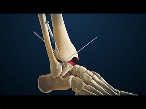 Arthrodesis | Arthroscopic Ankle Fusion Surgery | Nucleus Health - YouTube