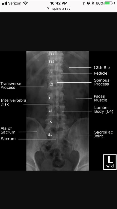 AP Lumbar Spine xray | Radiology imaging, Medical ultrasound ...