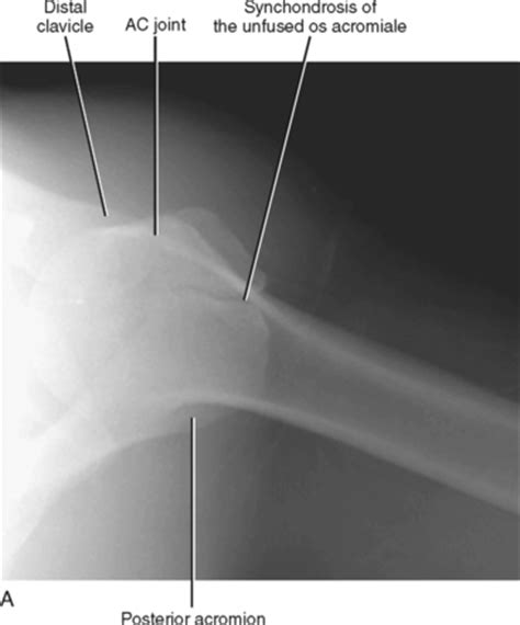 IMAGING OF THE SHOULDER | Radiology Key