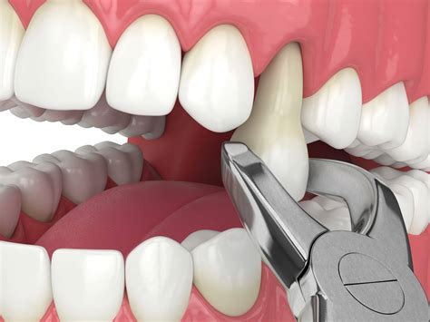 Tooth Extraction - Kind Dental of La Mesa - La Mesa, CA