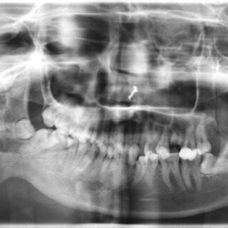 Preoperative orthopantomogram showing distorted anatomy of right TMJ ...