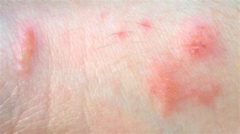 poison oak rash pictures - pictures, photos