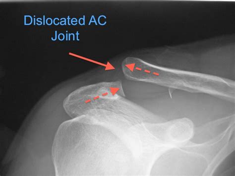 Acromioclaivicular Joint Dislocation - Dr. Terry Hammond