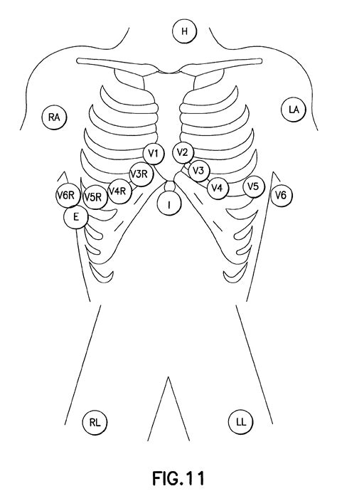 [DIAGRAM] Pediatric Ekg 15 Lead Placement Diagram - MYDIAGRAM.ONLINE