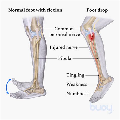 Treatment For Nerve Entrapment On Top Of Foot Online | emergencydentistry.com