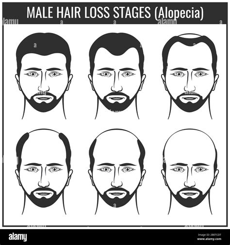 Details 136+ types of hair loss male - tnbvietnam.edu.vn