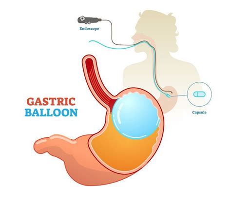 How Does the Gastric Balloon System Work?