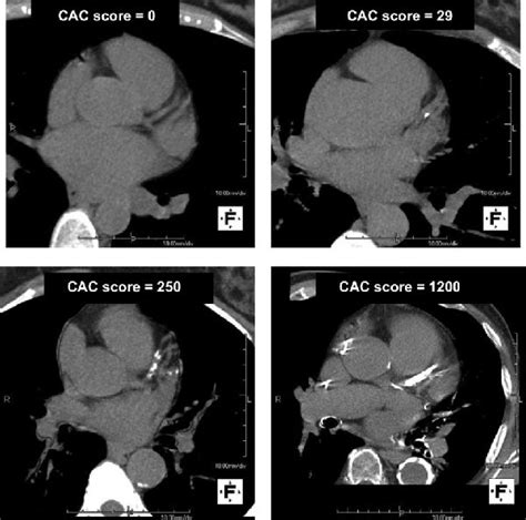 Coronary artery calcium scoring — Is it useful? - Dr Ross Walker