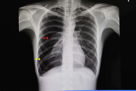 Chest X Ray Pneumothroax Or No Pneumothorax Youtube - vrogue.co