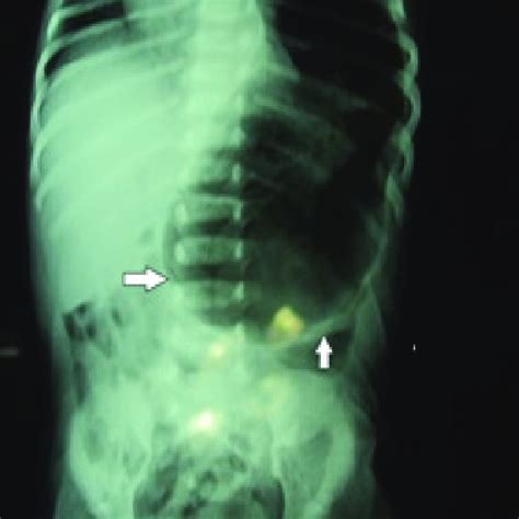 Serosal tear at the anterior wall of the stomach extending from the... | Download Scientific Diagram