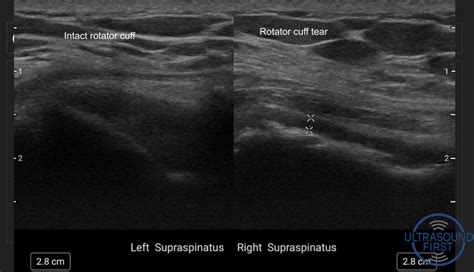 Rotator Cuff Tears - Ultrasound First