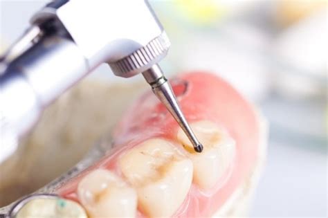 5 Fascinating Dental Drill Facts