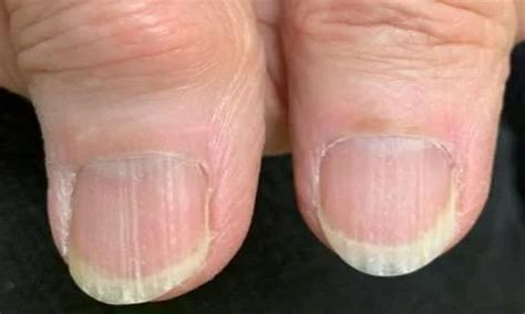 Nutritional Deficiency Red Flags as Indicated by Your Nails! - Supari.in