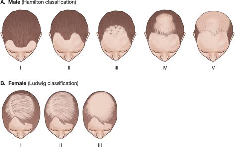 31 DISORDERS OF HAIR FOLLICLES AND RELATED DISORDERS | Plastic Surgery Key