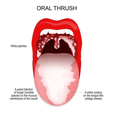 What Is Thrush In Your Mouth Top Sellers | www.kieranlabel.com