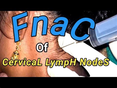 Fnac of Cervical Lymph Nodes ।। - YouTube