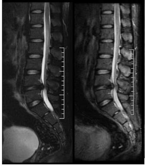 Gambar 1. Hasil Gambar MRI Lumbal Potongan Sagital Teknik Fat... | Download Scientific Diagram