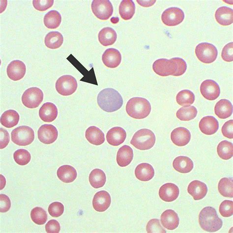 Polychromasia | Test Findings - MedSchool