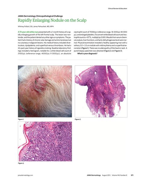 JAMA Network | JAMA Dermatology | Rapidly Enlarging Nodule on the Scalp