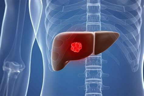 Liver Resection May Close Racial Gap in Overall Survival Among Patients ...