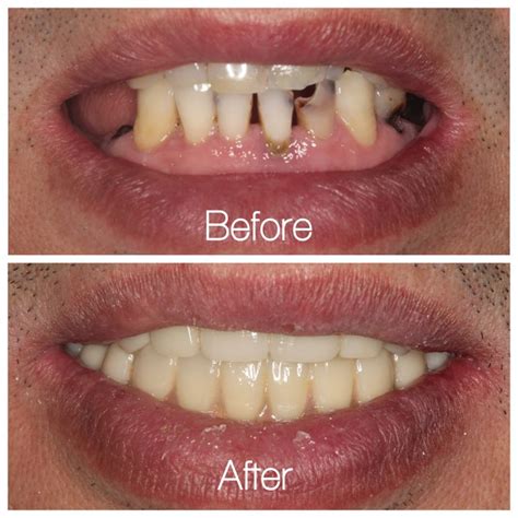 Before and After: Successful full mouth implants/restoration! - Dental Implants Chantilly Fairfax