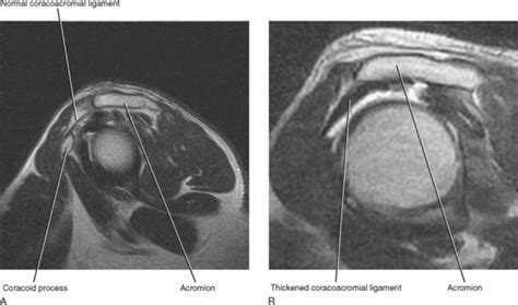 IMAGING OF THE SHOULDER | Radiology Key