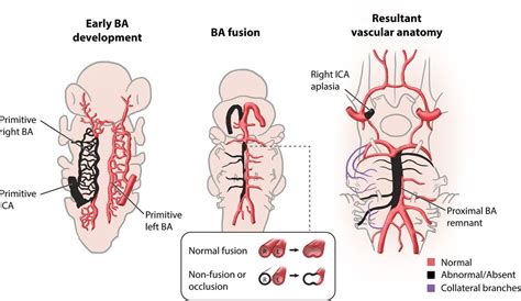 Concomitant carotid aplasia and basilar artery occlusion in a child with PHACES syndrome | BMJ ...