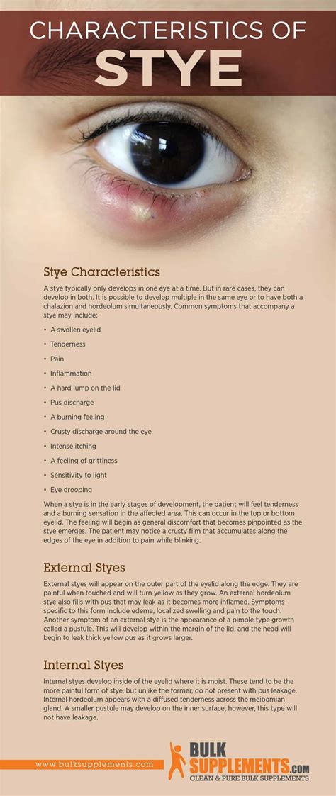 Stye: Characteristics, Causes & Treatment