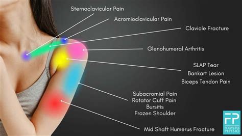 Shoulder Pain Diagnosis Chart | Shoulder Pain Location Chart