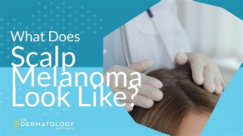 What Does Scalp Melanoma Look Like? - YouTube