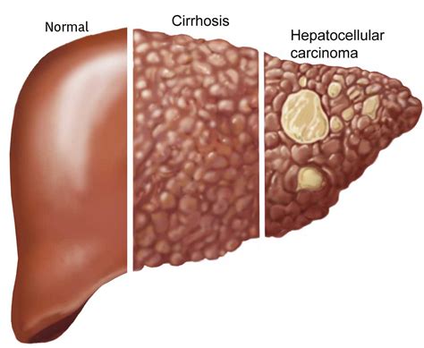 Liver Tumor Dr. Pradeep Muley M.D. Senior Consultant Interventional Radiologist