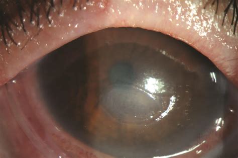 Stevens-Johnson syndrome - American Academy of Ophthalmology