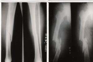 Floating Knee - Physiopedia