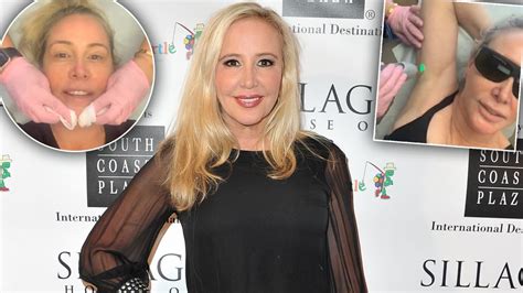 'RHOC' Star Shannon Beador Going Overboard With Plastic Surgery