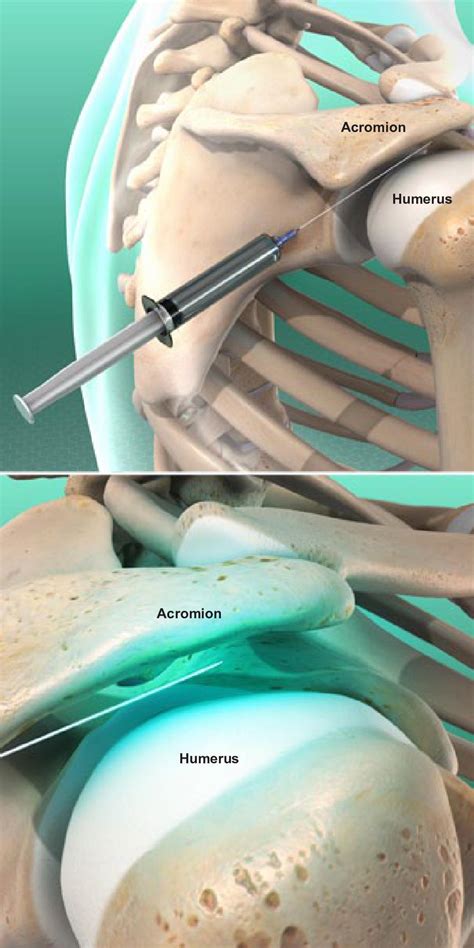 Subacromial Bursitis Injection