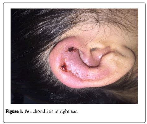 Auricular Perichondritis Complicating Helical Ear Piercing