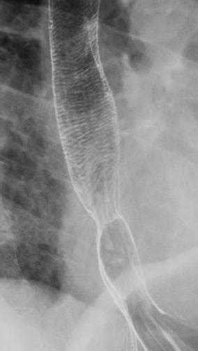 Feline esophagus. Upright, left posterior oblique spot image from... | Download Scientific Diagram