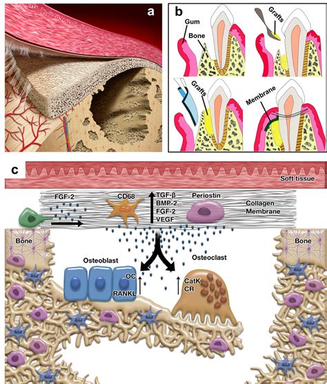 Resorbable Membranes for Guided Bone Regeneration: Critical Features ...