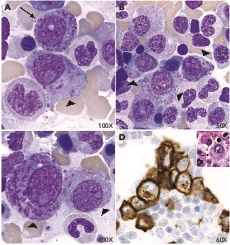 Neoplastic plasma cells with azurophilic crystalline inclusions mimicking promyelocytes